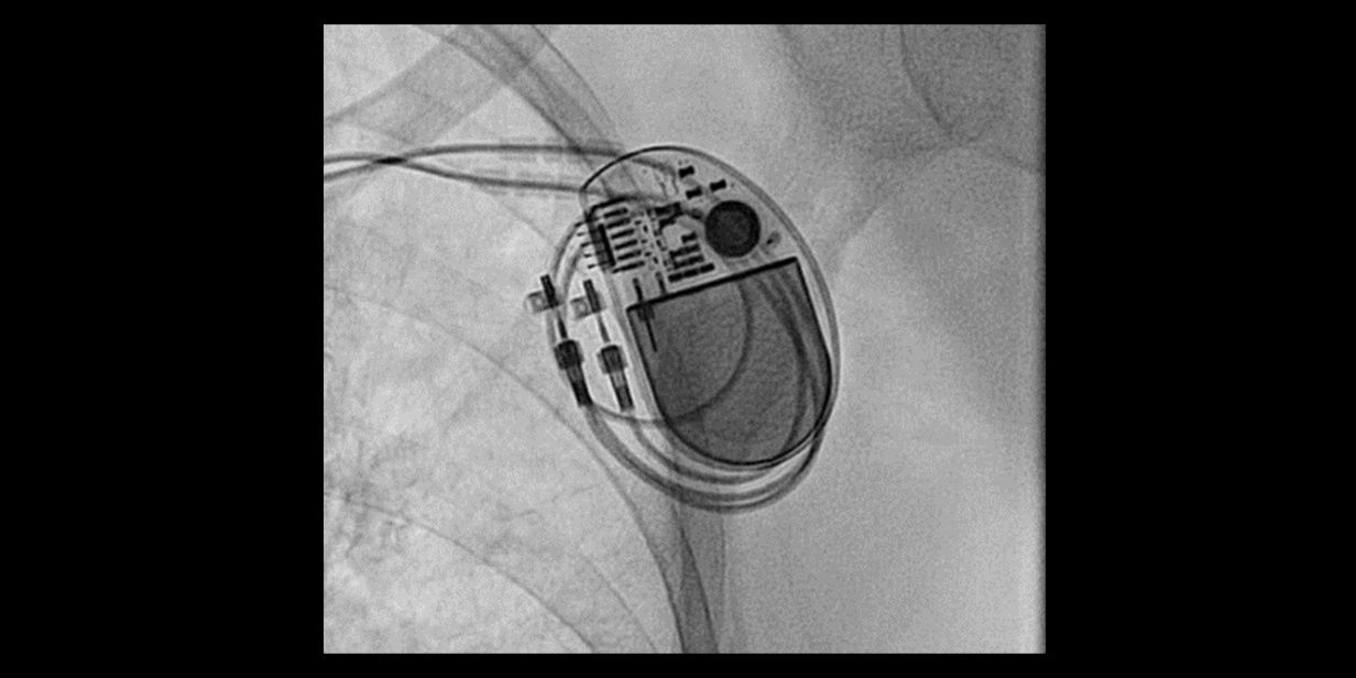Herzschrittmacher und interner Cardioverter-Defibrillator (ICD ...